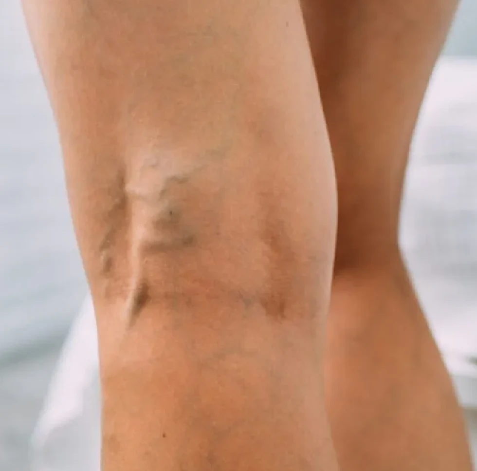 Varicose vein specialist in Ludhiana
