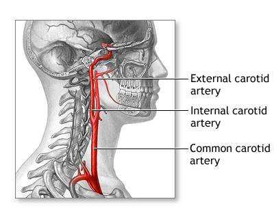 Carotid Artery Disease Specialist in Ludhiana
