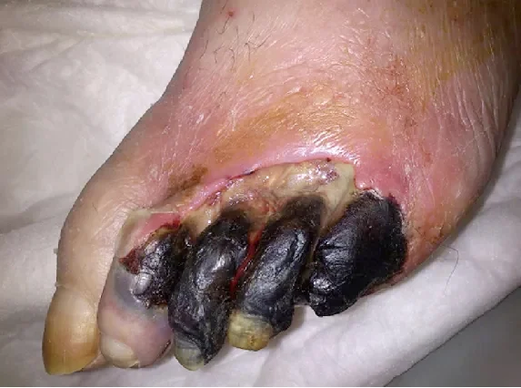 Gangrene doctor in Ludhiana
